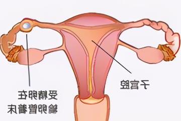 8个征兆说明你宫外孕了,腹痛和阴道出血是最常见的症状