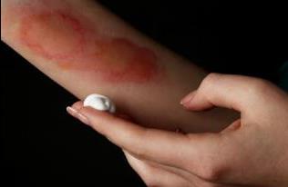 女生皮肤烫伤了该怎么办，第一时间冷水冲洗15-20分钟